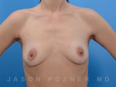 Breast Augmentation Before & After Gallery - Patient 19057063 - Image 1