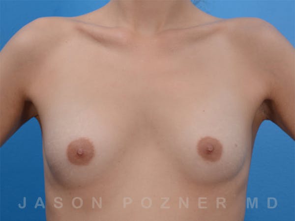 Breast Augmentation Before & After Gallery - Patient 19057066 - Image 1