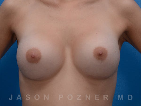 Breast Augmentation Before & After Gallery - Patient 19057066 - Image 2