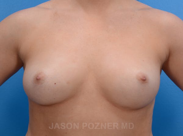 Breast Augmentation Before & After Gallery - Patient 19057073 - Image 1