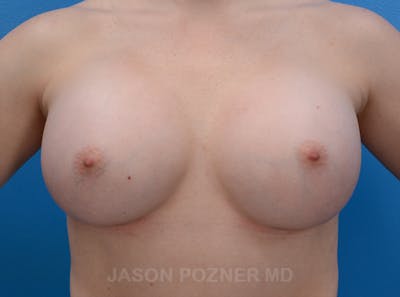 Breast Augmentation Before & After Gallery - Patient 19057073 - Image 2