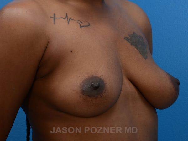 Breast Augmentation Gallery - Patient 19057077 - Image 1
