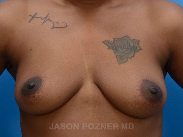 Breast Augmentation Gallery - Patient 19057077 - Image 3