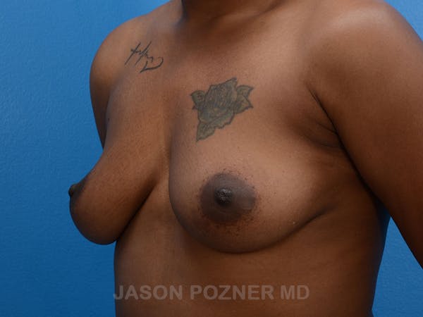Breast Augmentation Gallery - Patient 19057077 - Image 5