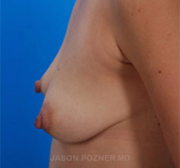 Breast Augmentation Before & After Gallery - Patient 19057083 - Image 3