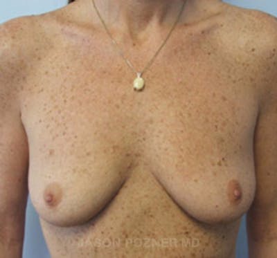 Breast Augmentation Before & After Gallery - Patient 19057088 - Image 1