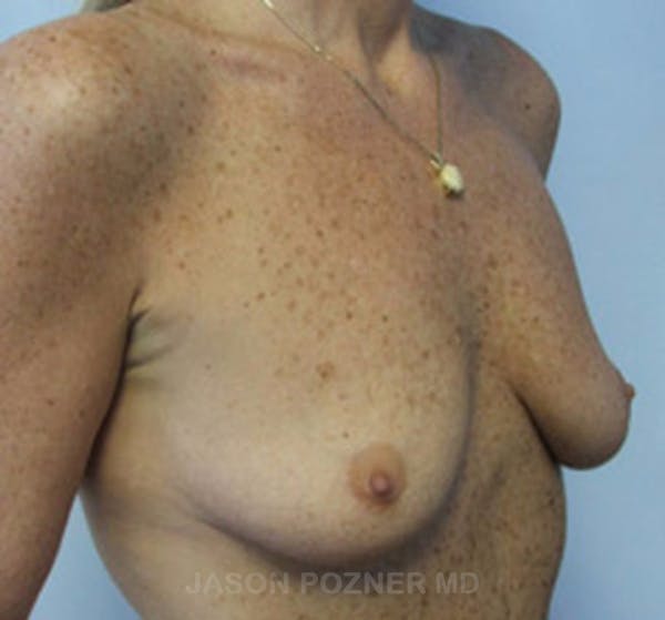 Breast Augmentation Before & After Gallery - Patient 19057088 - Image 3