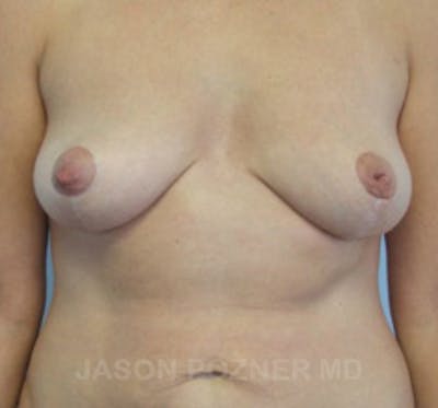 Breast Lift Gallery - Patient 19057099 - Image 2