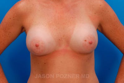 Breast Augmentation Before & After Gallery - Patient 19057101 - Image 2