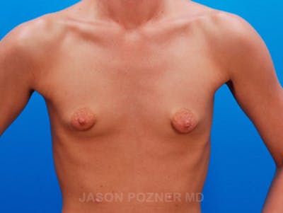 Breast Augmentation Before & After Gallery - Patient 19057104 - Image 1
