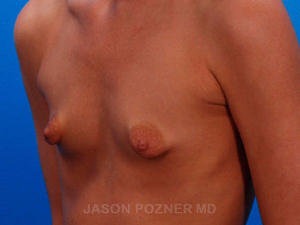Breast Augmentation Before & After Gallery - Patient 19057104 - Image 3