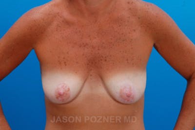 Breast Augmentation Before & After Gallery - Patient 19057106 - Image 1