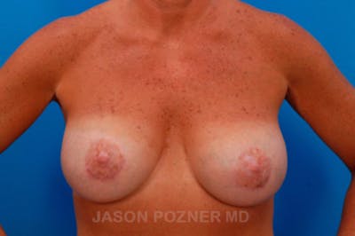 Breast Augmentation Before & After Gallery - Patient 19057106 - Image 2