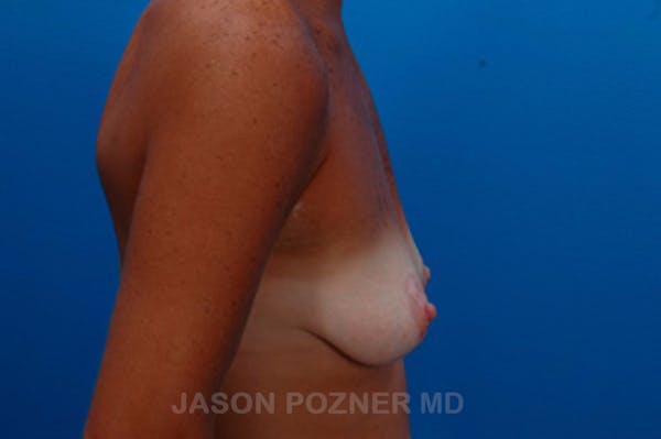 Breast Augmentation Before & After Gallery - Patient 19057106 - Image 3