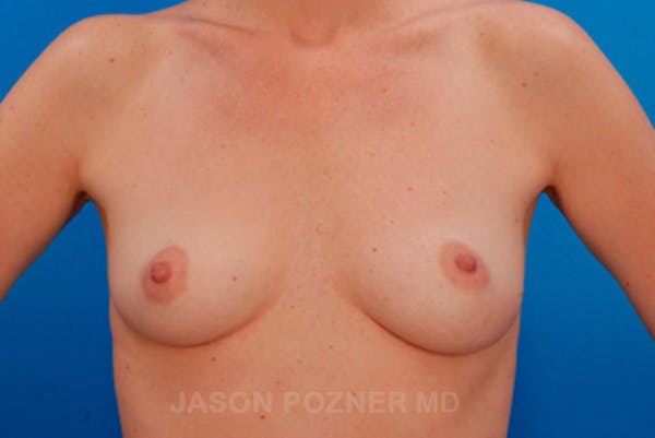 Breast Augmentation Before & After Gallery - Patient 19057108 - Image 1