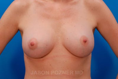 Breast Augmentation Before & After Gallery - Patient 19057108 - Image 2