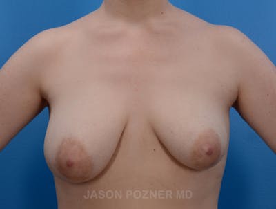 Breast Augmentation Before & After Gallery - Patient 19057110 - Image 1