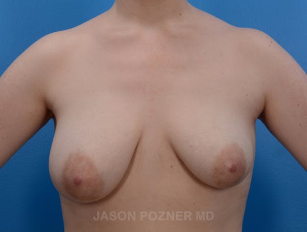Breast Augmentation Before & After Gallery - Patient 19057110 - Image 1