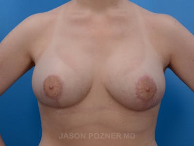 Breast Augmentation Before & After Gallery - Patient 19057110 - Image 2