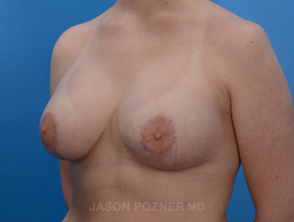 Breast Augmentation Before & After Gallery - Patient 19057110 - Image 4