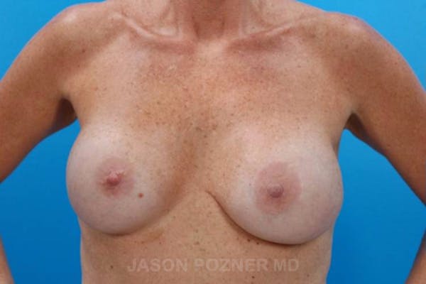 Breast Reduction Before & After Gallery - Patient 19072941 - Image 1