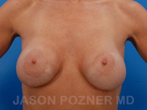 Breast Revision