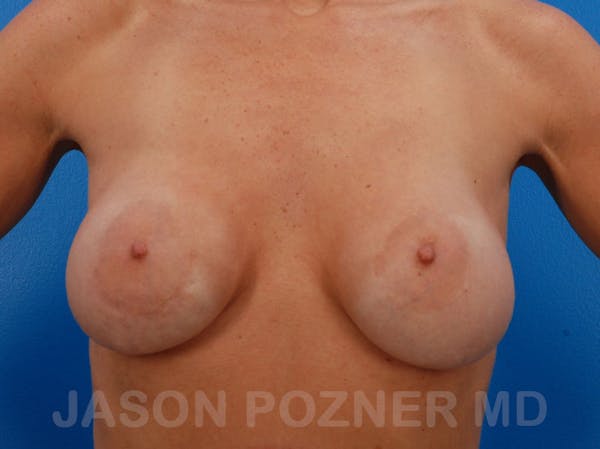 Breast Revision Before & After Gallery - Patient 19072945 - Image 1