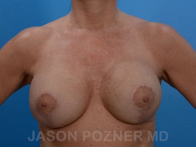 Breast Revision Before & After Gallery - Patient 19072946 - Image 1