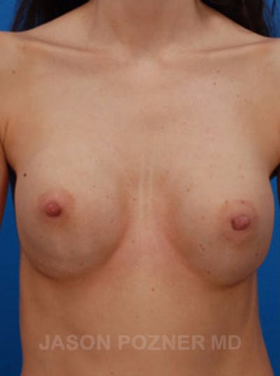 Breast Revision Gallery - Patient 19072949 - Image 1