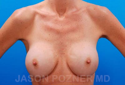 Breast Revision Before & After Gallery - Patient 19072950 - Image 1