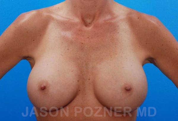 Breast Revision Before & After Gallery - Patient 19072950 - Image 2