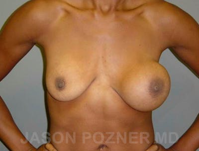 Breast Revision Before & After Gallery - Patient 19072952 - Image 1