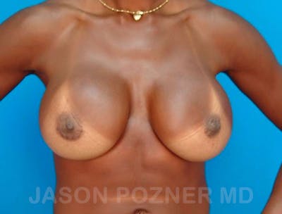 Breast Revision Before & After Gallery - Patient 19072952 - Image 2