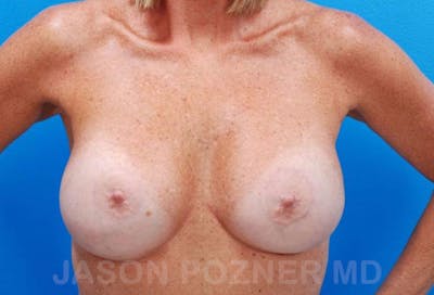 Breast Revision Before & After Gallery - Patient 19072953 - Image 2