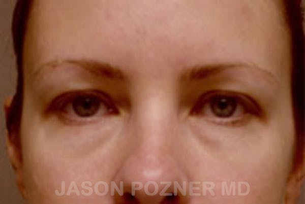 Blepharoplasty Before & After Gallery - Patient 19072972 - Image 1