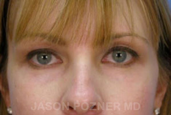 Blepharoplasty Before & After Gallery - Patient 19072972 - Image 2