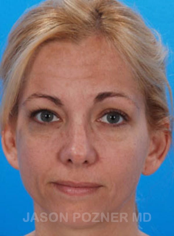 Blepharoplasty Before & After Gallery - Patient 19072974 - Image 1