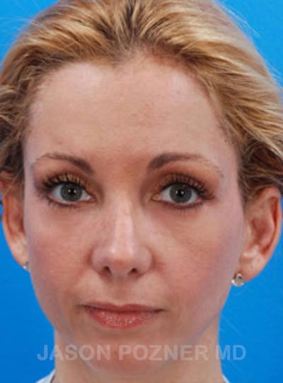 Blepharoplasty Before & After Gallery - Patient 19072974 - Image 2