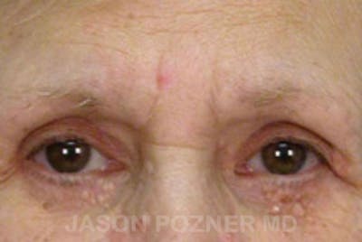 Brow Lift Before & After Gallery - Patient 19072979 - Image 1