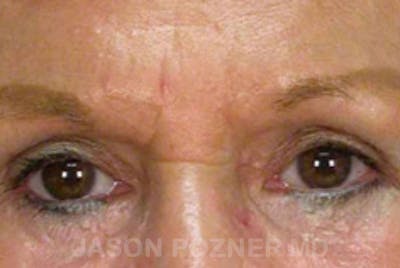 Brow Lift Before & After Gallery - Patient 19072979 - Image 2
