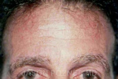 Brow Lift Before & After Gallery - Patient 19072981 - Image 1