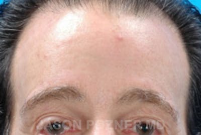 Brow Lift Before & After Gallery - Patient 19072981 - Image 2
