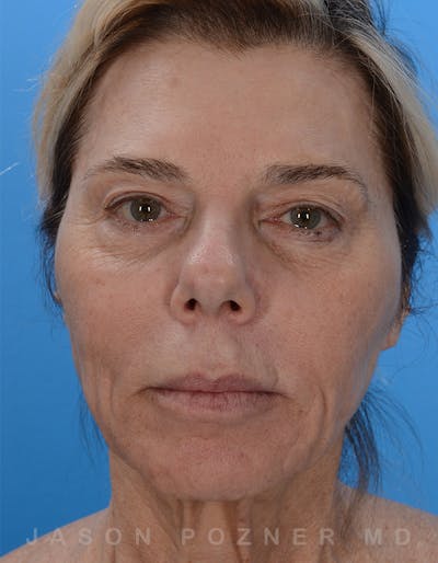 Facelift Before & After Gallery - Patient 19072998 - Image 1