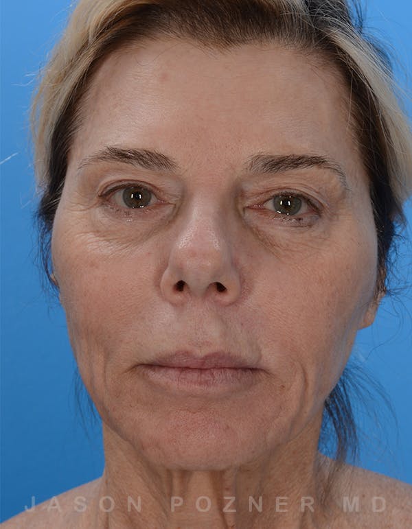 Facelift Before & After Gallery - Patient 19072998 - Image 1
