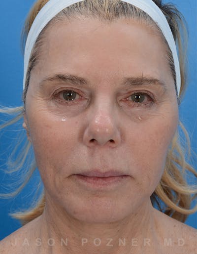 Facelift Before & After Gallery - Patient 19072998 - Image 2