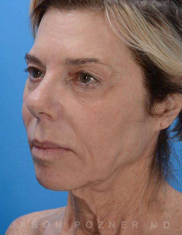 Facelift Before & After Gallery - Patient 19072998 - Image 3