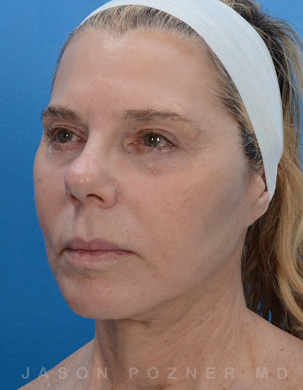 Facelift Before & After Gallery - Patient 19072998 - Image 4