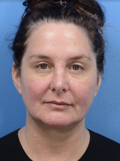 Facelift Before & After Gallery - Patient 19073000 - Image 1