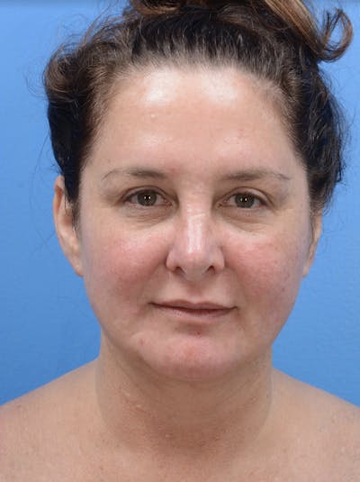 Facelift Before & After Gallery - Patient 19073000 - Image 2