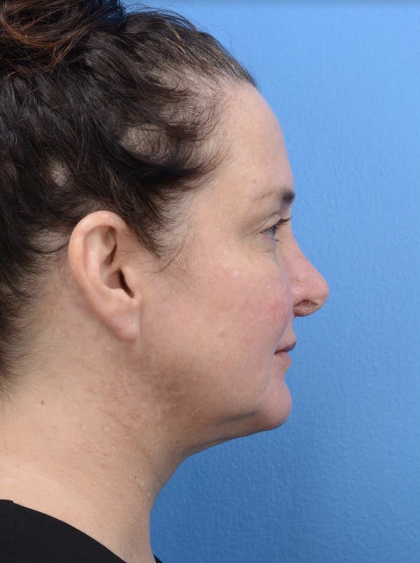 Facelift Before & After Gallery - Patient 19073000 - Image 3